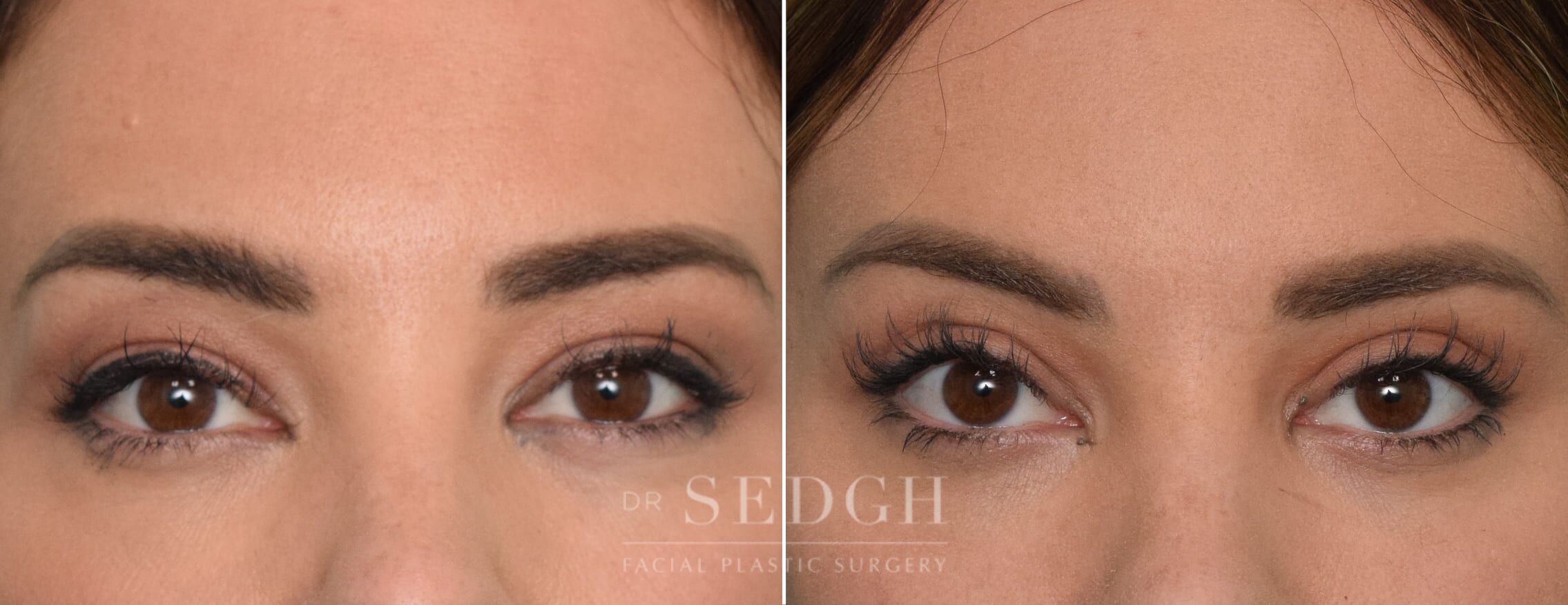 Upper Blepharoplasty Before and After Photos Dr. Sedgh Upper Blepharoplasty Before and After Photos Dr. Sedgh